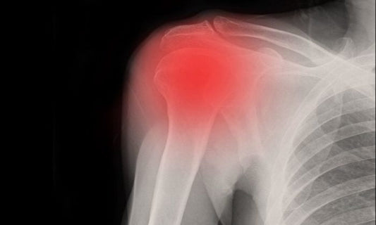 What’s the best way to treat a frozen shoulder? Ice it!